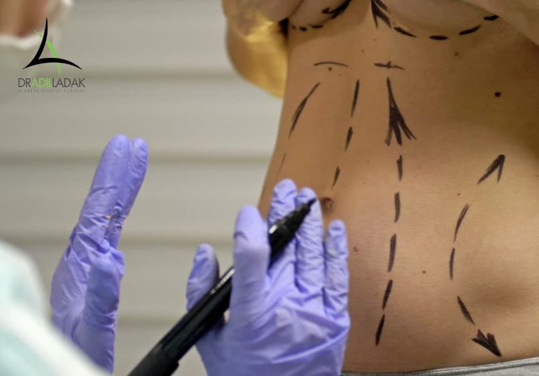 Popular Treatment Areas for Liposuction – Liposuction Edmonton